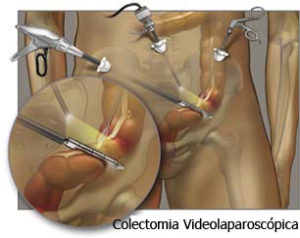 Colectomia-Videoaparoscópica